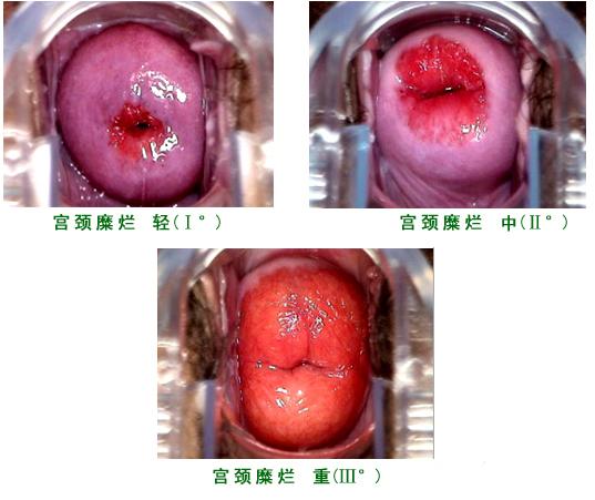 宫颈糜烂最新手术治疗，重拾自信与健康的秘诀✨