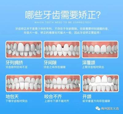 最新牙齿矫正技术,最新牙齿矫正技术，步骤指南